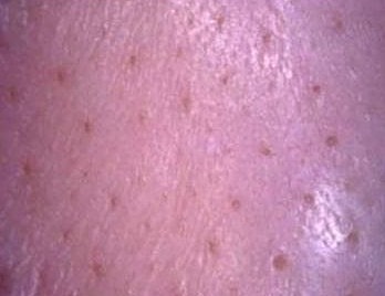 Close-up of textured skin surface.