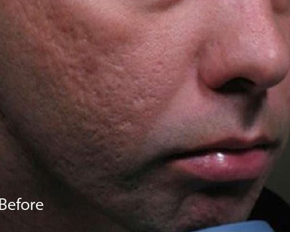 Skin texture before treatment showing scars and blemishes.