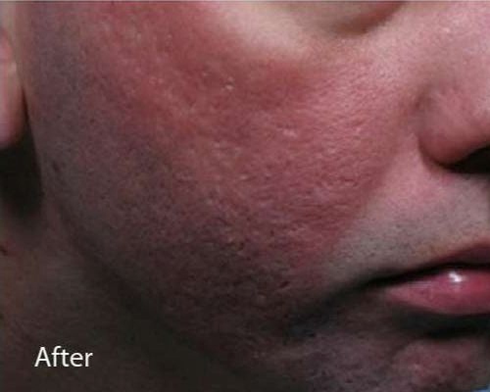 Post-treatment skin showing redness and texture.