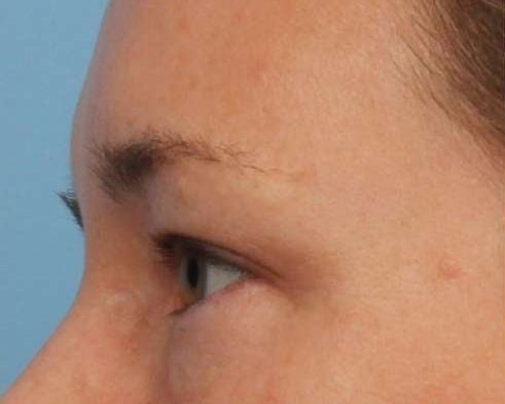 Close-up of a person's eye and forehead.