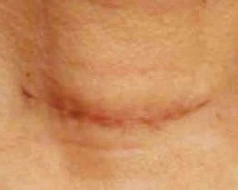 Scar on skin surface.