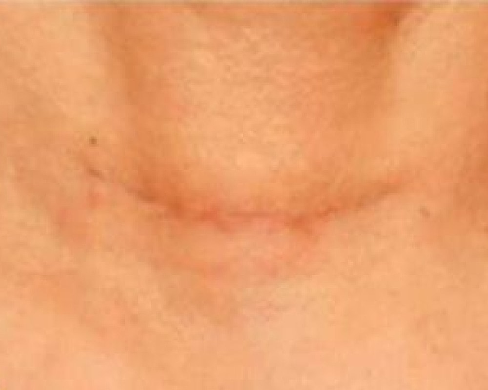 Skin close-up with a visible scar line