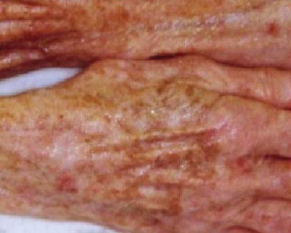 Close-up of aged hands with skin discoloration.