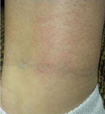 Skin with redness and discoloration on ankle.