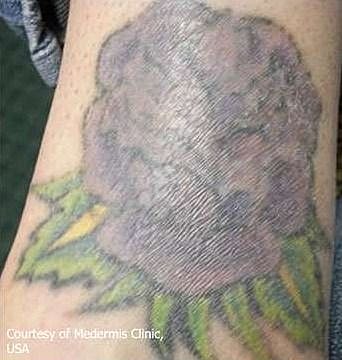 Faded tattoo of a flower on forearm.