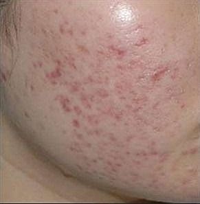Close-up of skin with acne and blemishes.