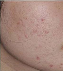 Skin with acne and blemishes.