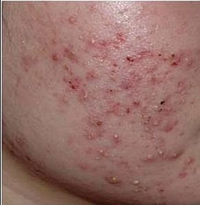 Skin with visible acne and blemishes.