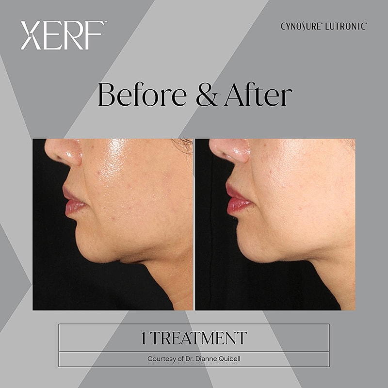 Before and after facial treatment comparison.