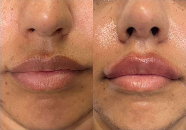 Before and after lip enhancement procedure comparison.