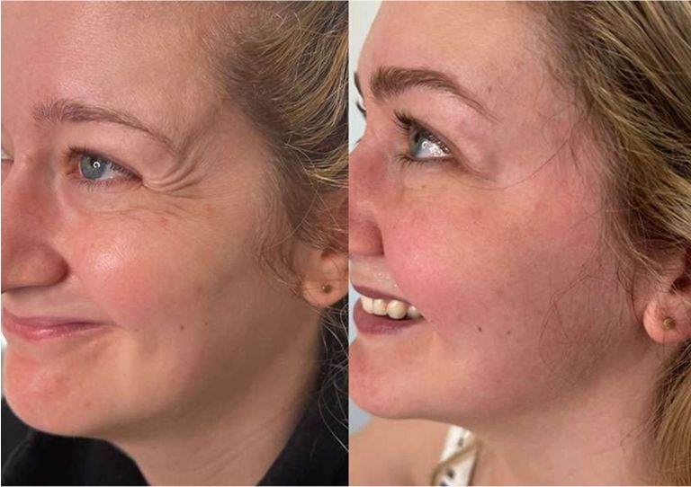 Before and after facial treatments comparison.