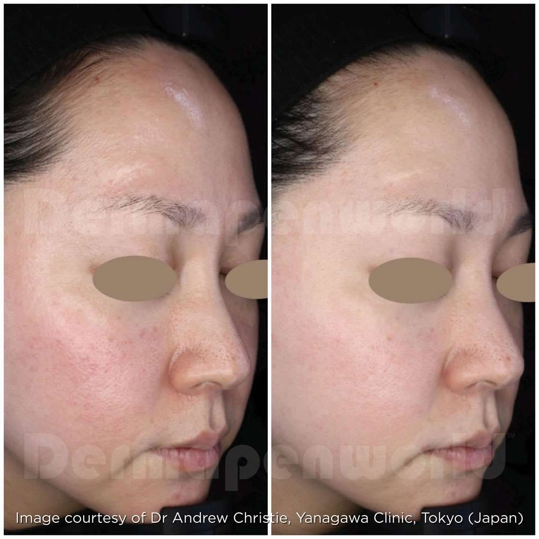 microneedling before and after 4