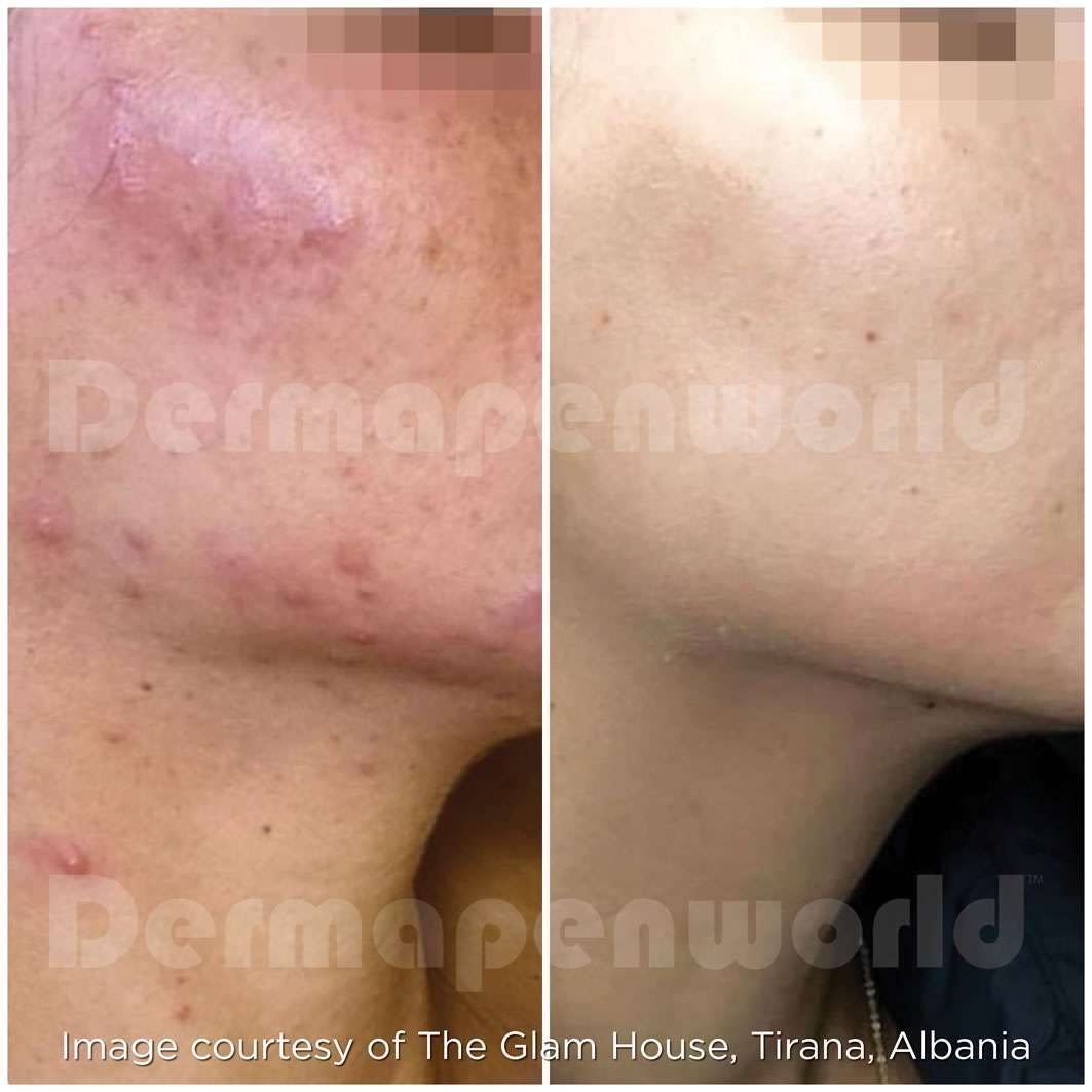 microneedling before and after 1
