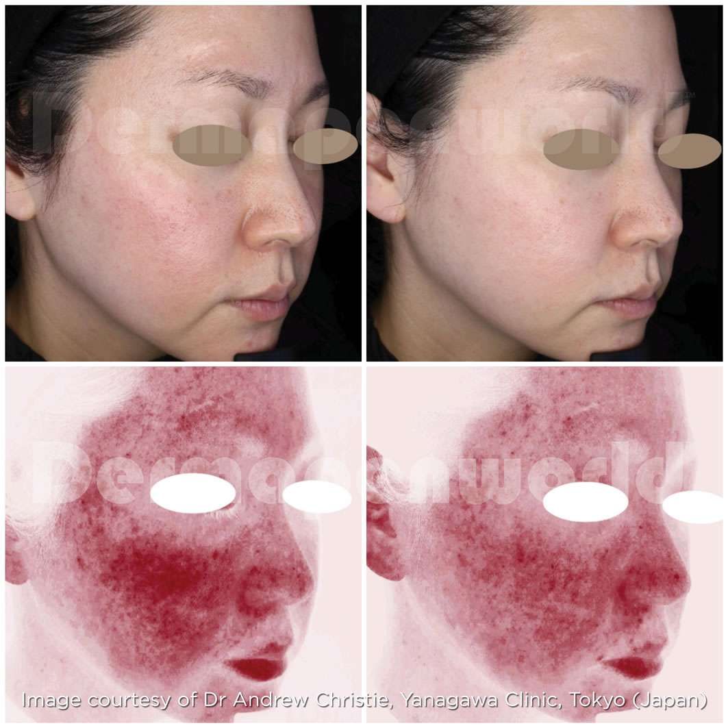 microneedling before and after  2