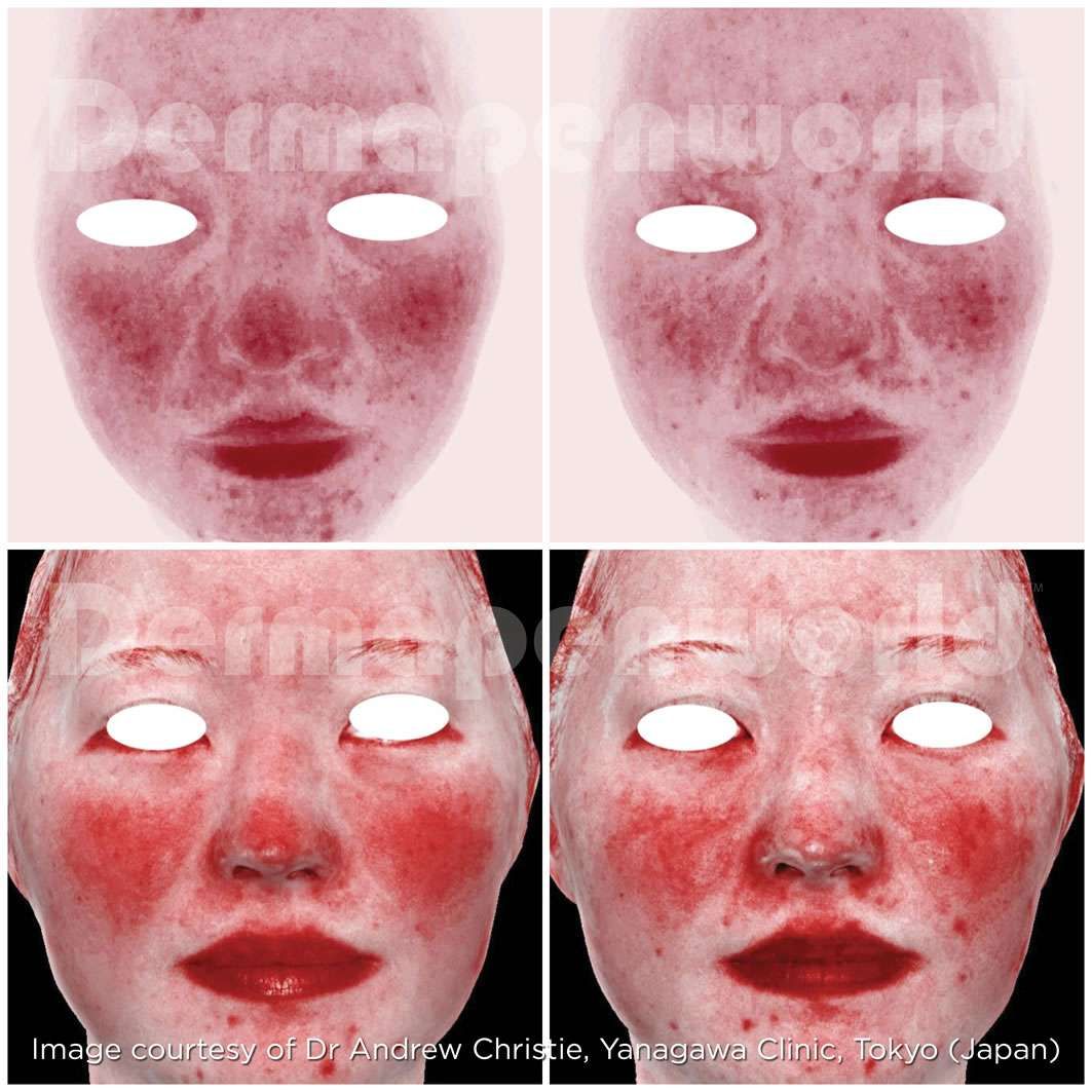 microneedling before and after 3