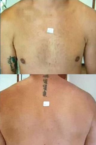 after hollywood laser peel for tattoo removal 1
