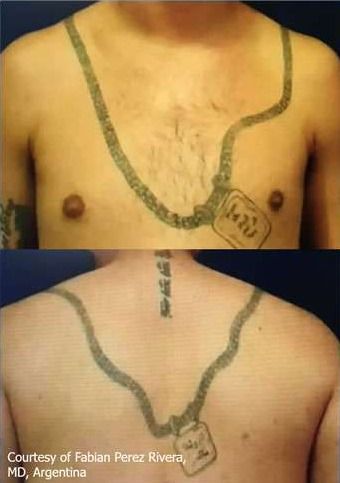 before hollywood laser peel for tattoo removal 1