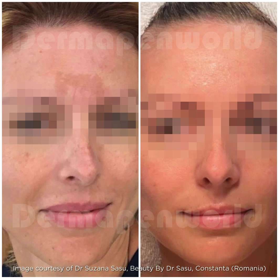 microneedling before and after 5